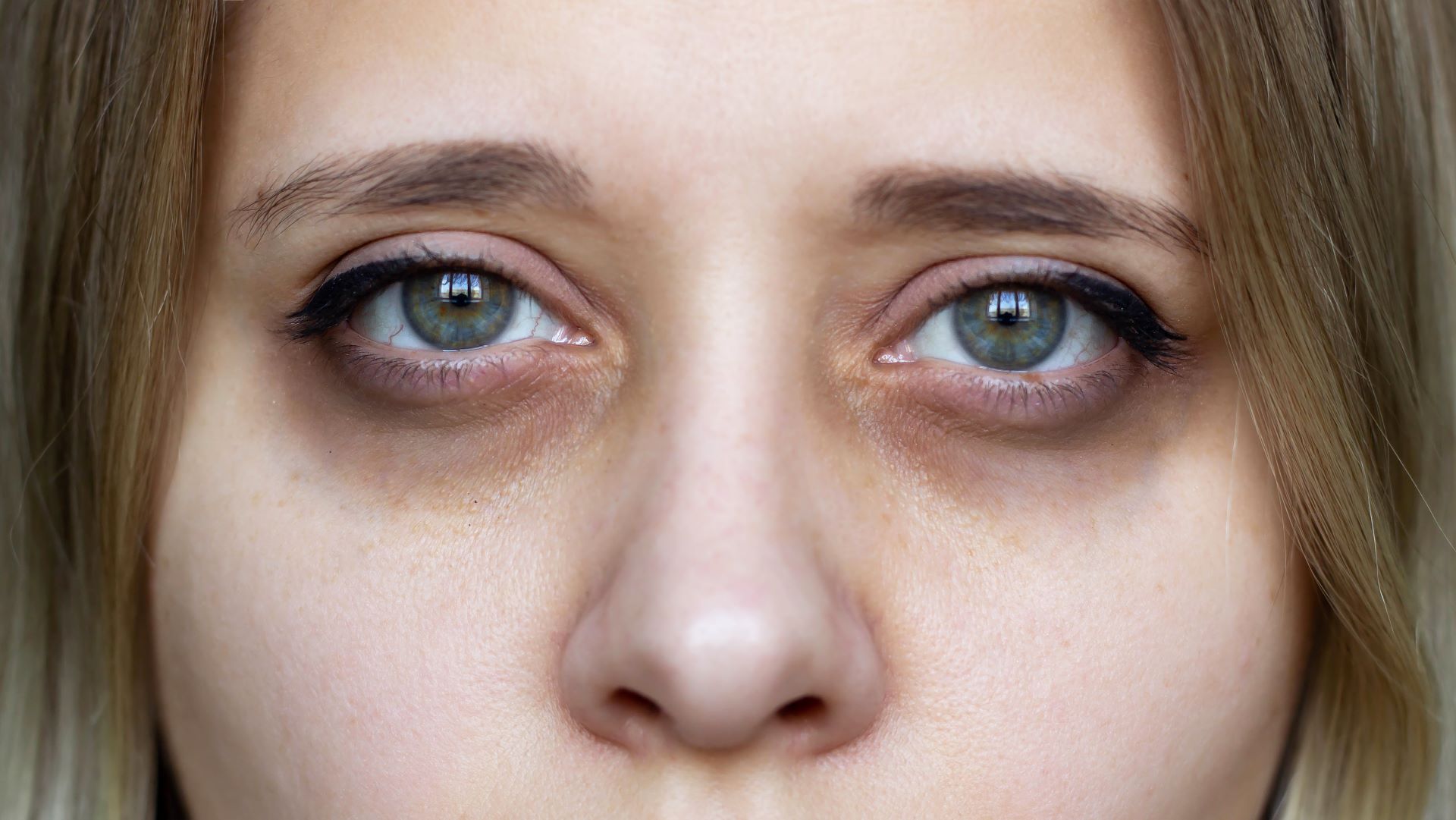 Müde Augen mit dunklen Augenringen